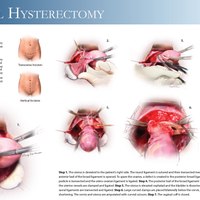 hysterectomy questions