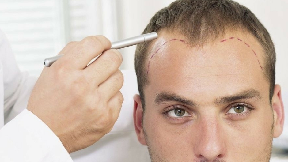 Istituto Giglio Soluzioni Calvizie