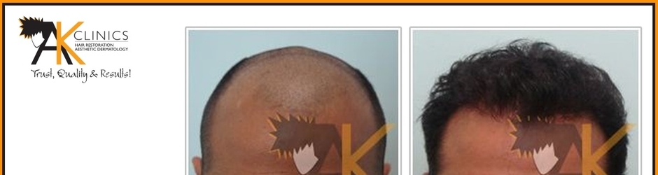AKClinics - Hair Transplant in India