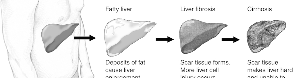 Alcohol and Liver Damage