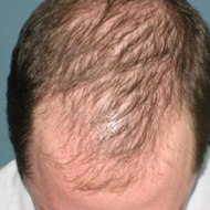 Na wypadanie włosów