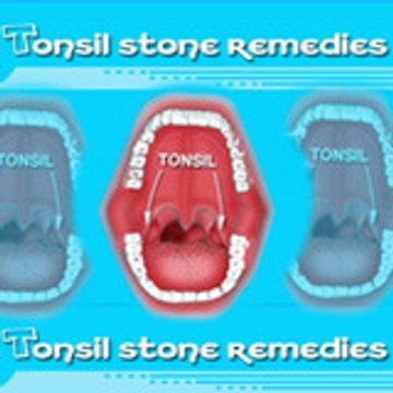 Tonsilstone Remedies