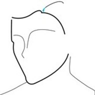 Hair Transplantation Medikemos