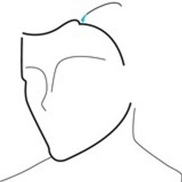 Hair Transplantation Medikemos