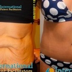 Tummytuck Cancun