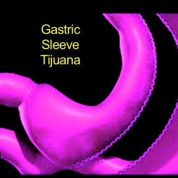 Gastric Sleeve Surgery Tijuana