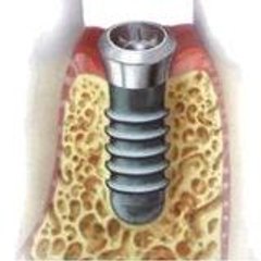 implantmarkalari