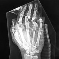 Finger Fracture