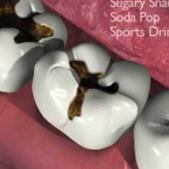 Dental Braces In Kelowna