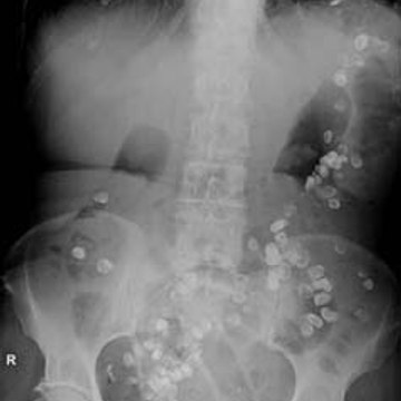 What Side is Your Appendix on