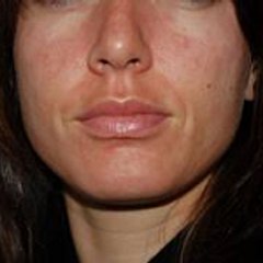Rash Around Mouth