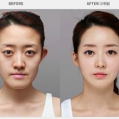Lee Min Ho Plastic Surgery