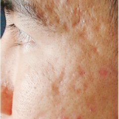 Pimple Sg