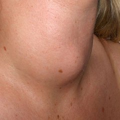 Hashimoto Thyroiditis