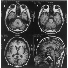 Cerebellar Ataxia