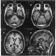 Cerebellar Ataxia