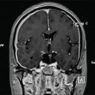 Pachymeningitis