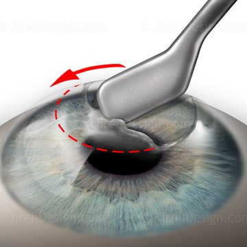 Keratectomy