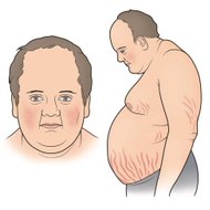 Cushing's Syndrome