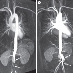 Takayasu Arteritis