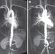 Takayasu Arteritis