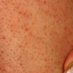 Keratosis Pilaris