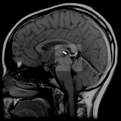 Pineal Region Tumor