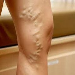 Porque Salen Las Varices y Como Eliminarlas