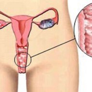 Candida Albicans Tratamiento