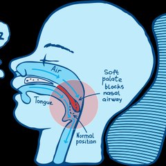 Antisnoringdevices