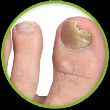 Cure Toenail Fungus