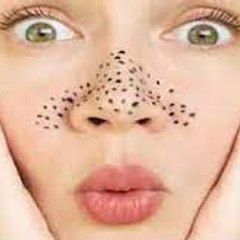 Blackheads Removal