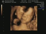 4D baby pregnancy ultrasound scan