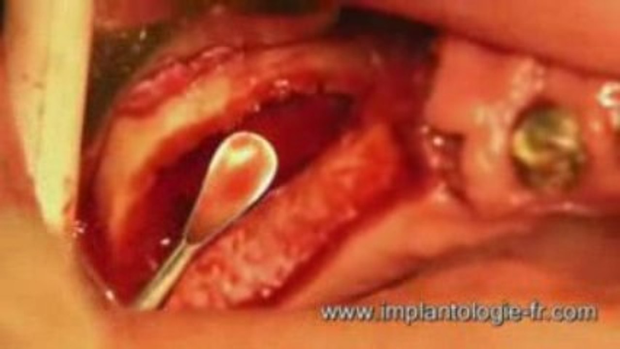 Sinus lift