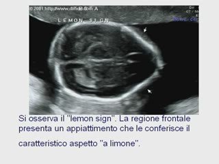 spina bifida diagnosi