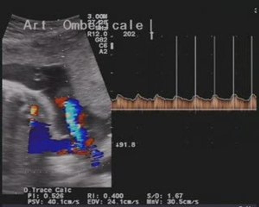 sospetta acondroplasia