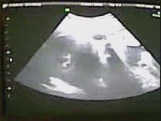 FILM échographie du 06 juillet 2009