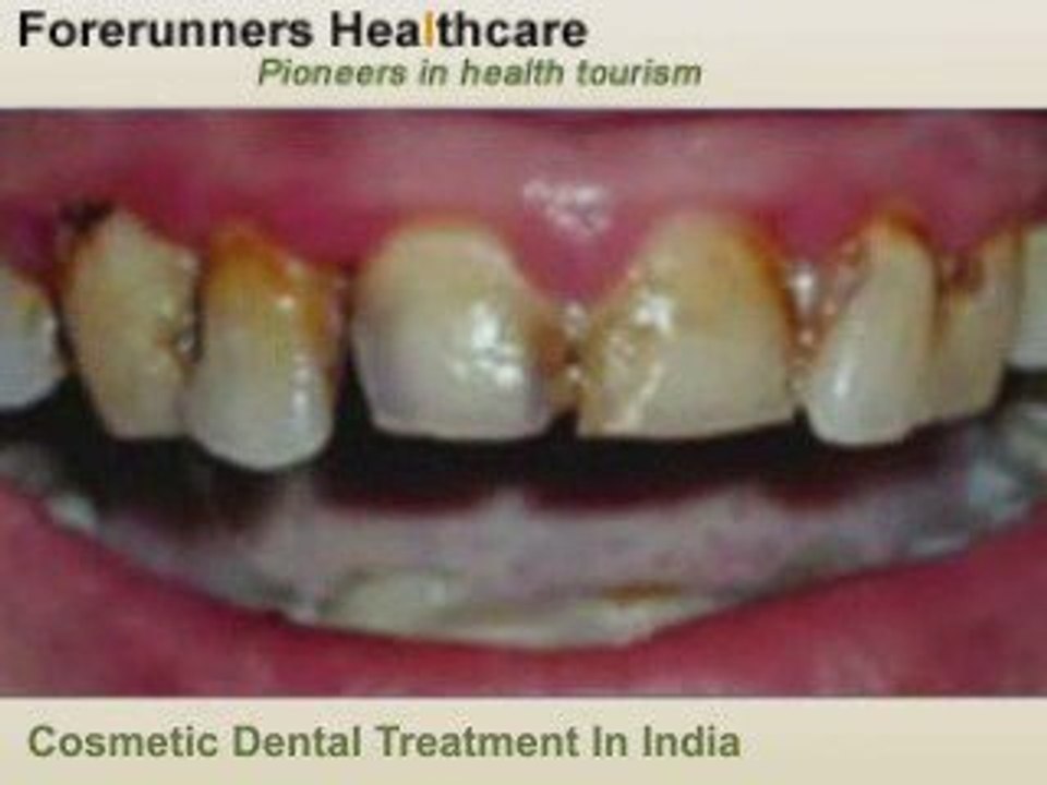 Cost Effective Cosmetic dental treatment in India