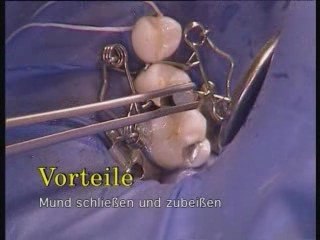 Walser® Teilmatrizen: Anwenderfilm in Zahnarztpraxis