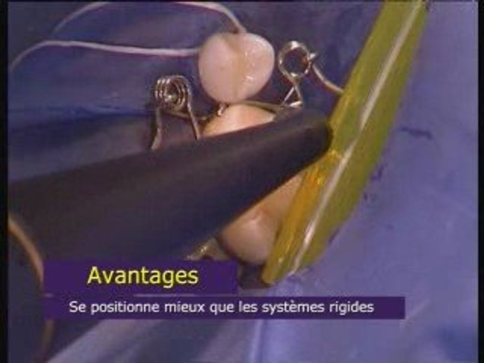 Walser® Matrices Sectionnelles: Film de l'utilisateur dans le pratique médecin de la dent