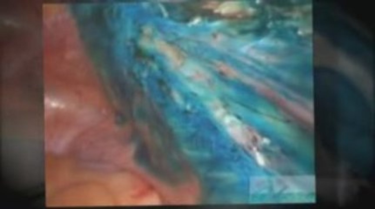 Video über Verwachsungen