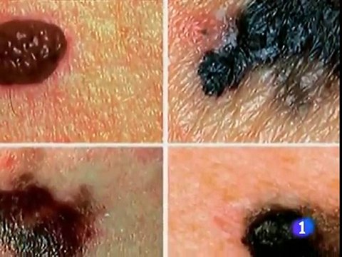 Melanoma: Cancer de piel