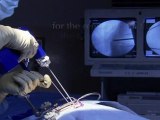 açık cerrahi diskektomi