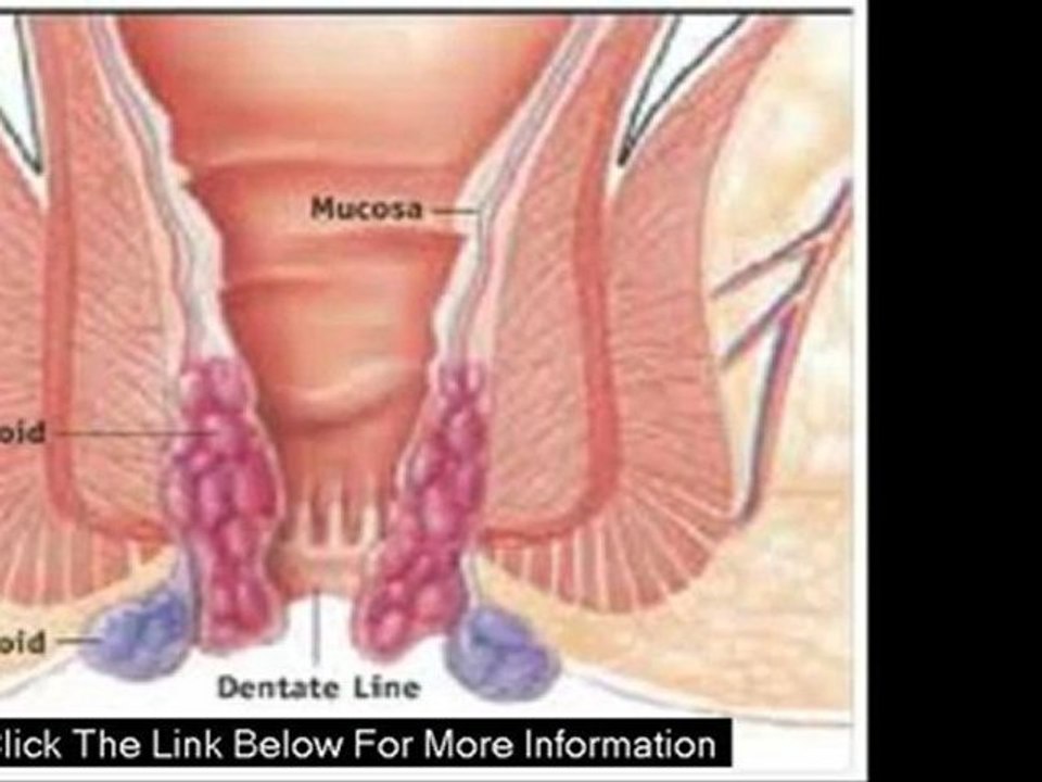 hemorrhoids therapy