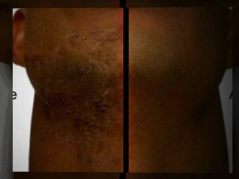 How To Get Rid Of Razor Bumps Fast