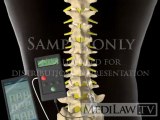 Lumbar Spinal Cord Trial Stimulation wire electrode medical trial videos