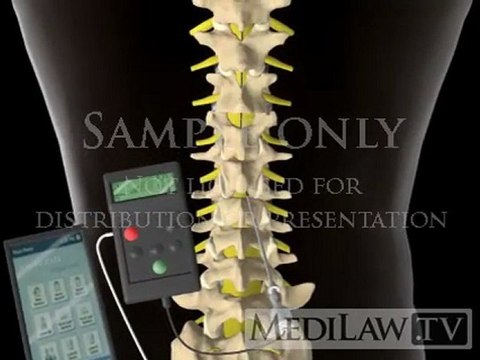 Lumbar Spinal Cord Trial Stimulation wire electrode medical trial videos