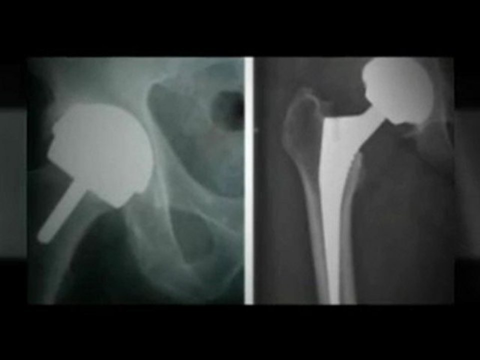 Zimmer Hip Recall Legal Advise