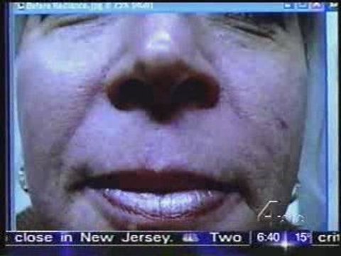 Botox, Restalyne, Chemical Peels, and Wrinkle Fillers beat b