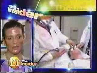 New Laser Skin Treatments to Repair Facial Scaring